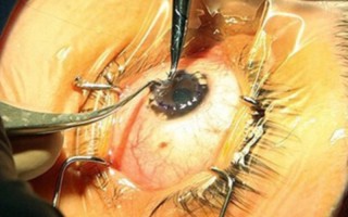 انجام اولین عمل پیوند قرنیه چشم در استان ایلام