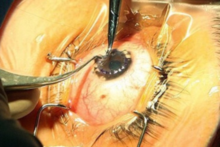 انجام اولین عمل پیوند قرنیه چشم در استان ایلام